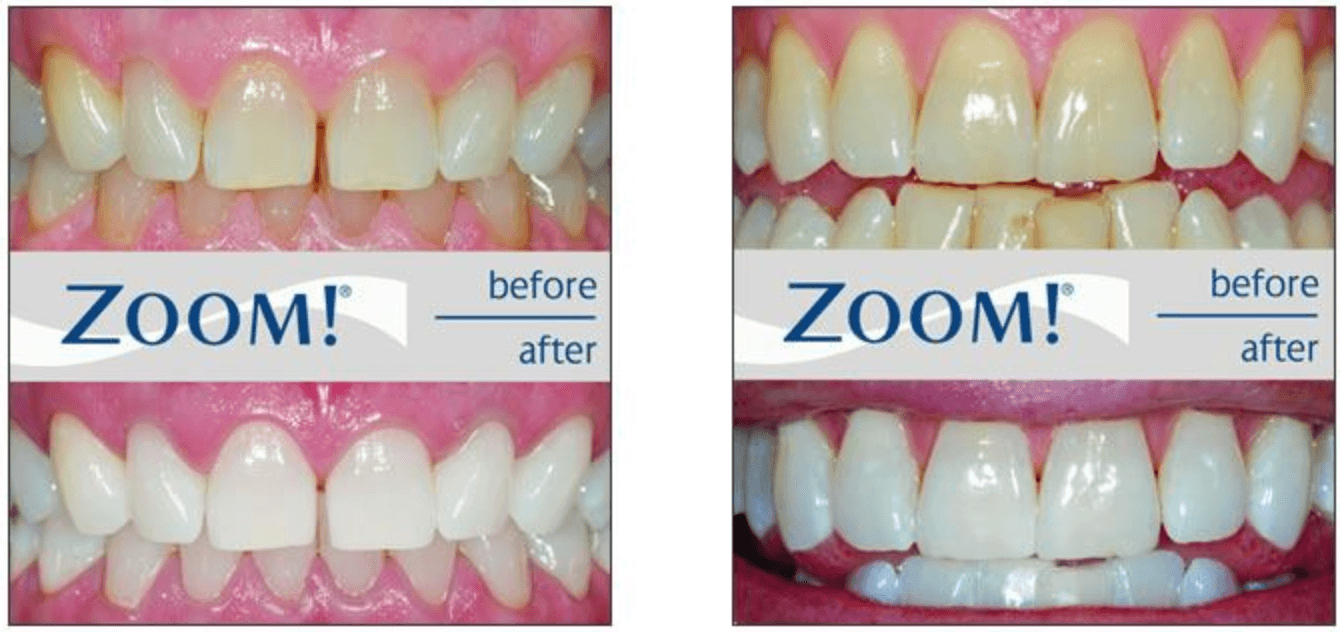 zoom teeth whitening cost