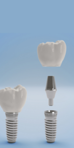Dental Implant